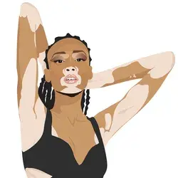 Winnie Harlow vitiligo model