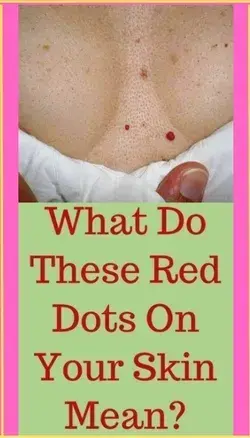 What Do These Red Dots On Your Skin Mean?