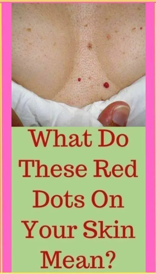 What Do These Red Dots On Your Skin Mean?