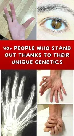 40+ People Who Stand Out Thanks To Their Unique Genetics