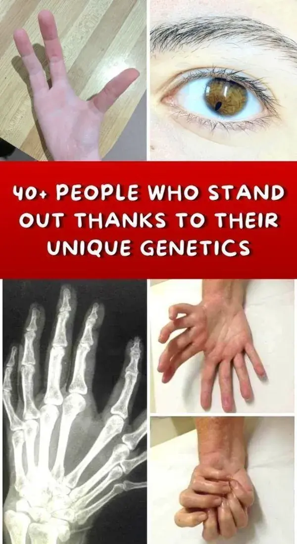 40+ People Who Stand Out Thanks To Their Unique Genetics