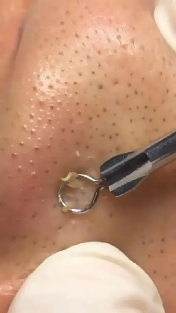 Oddly satisfying blackhead removal