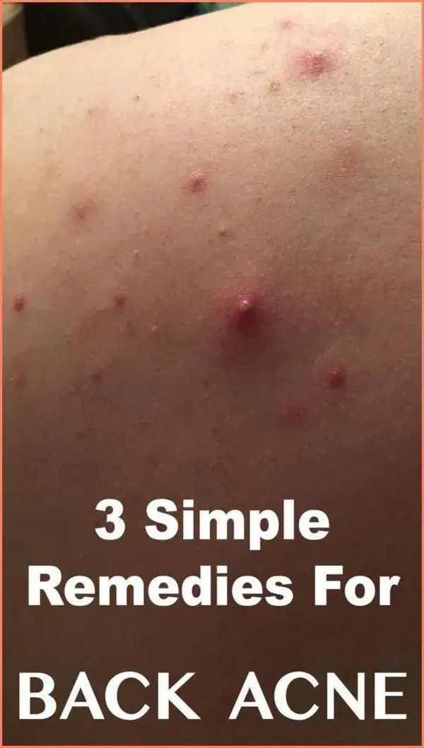 3 Best Remedies For Back Acne