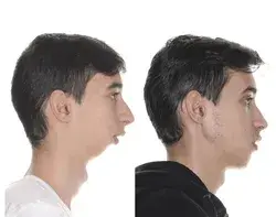 Orthognathic surgery for jaw definition