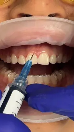 Composite veneers - Kissdental