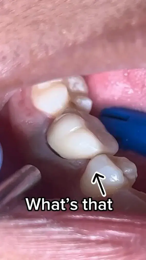 Teeth Fixing