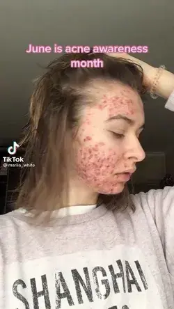 Acne transformation