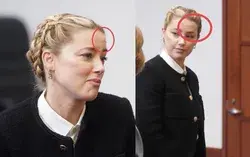 After her sister testified, Amber Heard came to the court with a scratch on her forehead