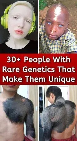 30+ People With Rare Genetics That Make Them Unique