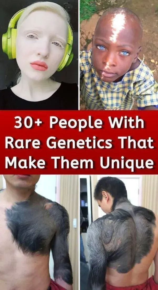 30+ People With Rare Genetics That Make Them Unique