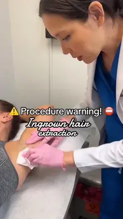 Ingrown hair extraction