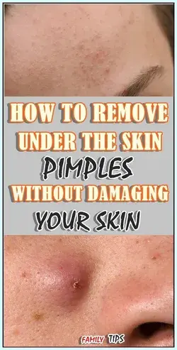 How to Remove Skin Tag in One Night