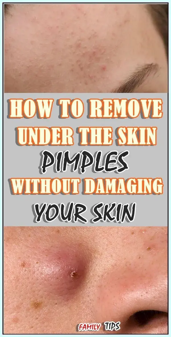 How to Remove Skin Tag in One Night