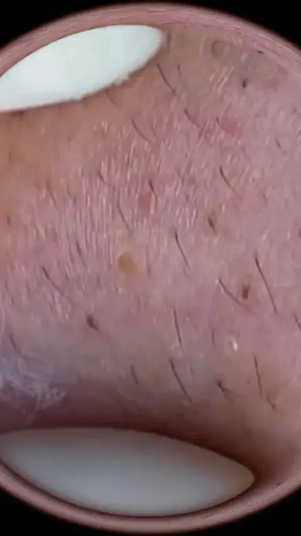 Satisfy#acne #blackhead #pimple #satisfying