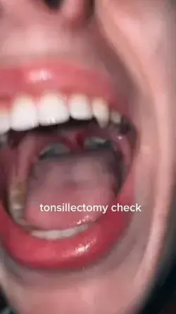 Tonsillectomy Check