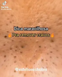 Dica Maravilhosa para remover Cravos e ter o melhor tratamento para a pele | SIGA PARA MAIS DICAS