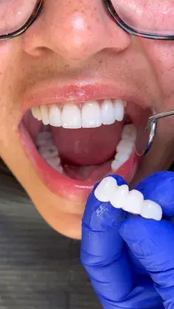 PLACING DENTAL BRIDGE