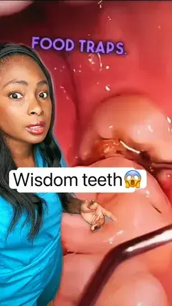 Wisdom teeth😱#hygienist #wisdomteeth #teeth