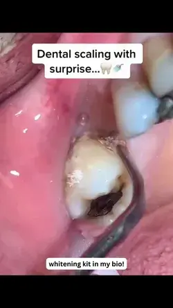 Dental Scaling With A Surprise!