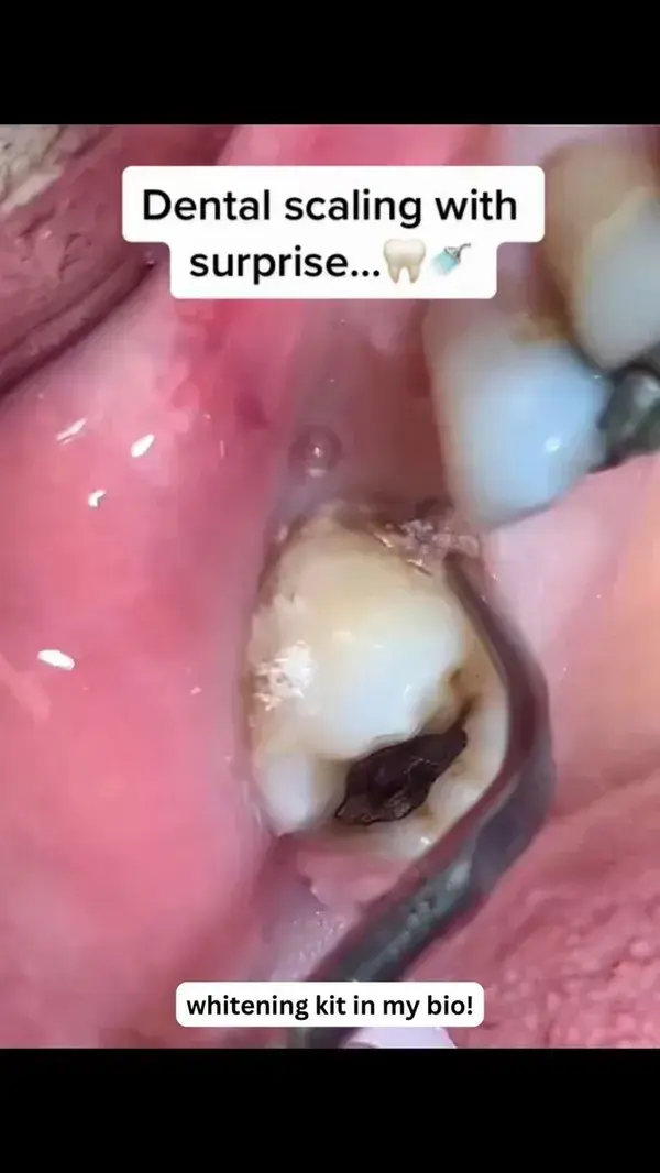 Dental Scaling With A Surprise!