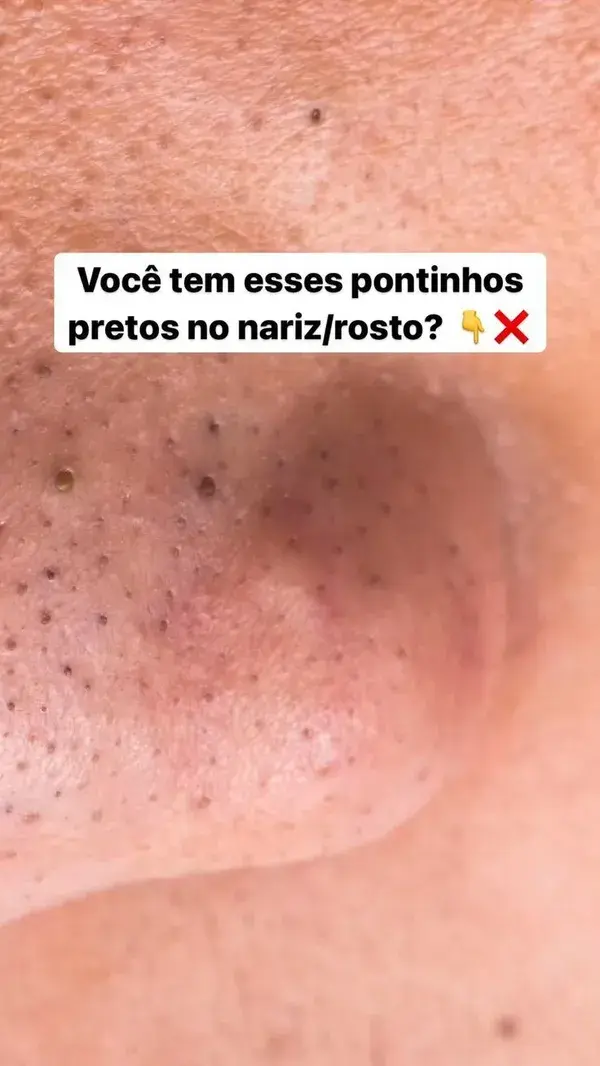 ESPINHAS E ACNES, E SEUS GRAUS NA PELE