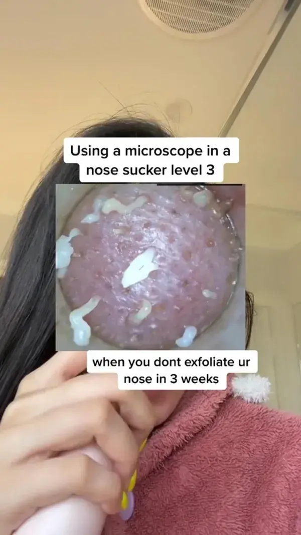 Blackhead Removal