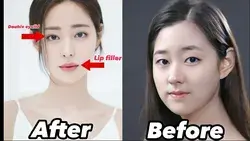 Unveiling Remarkable Transformations: Korean Plastic Surgery Before & After