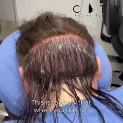 Hair Restoration video