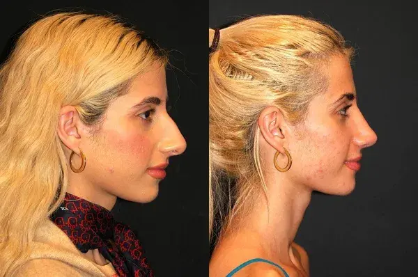 Rhinoplasty Before & After - Dr. Andrew Jacono