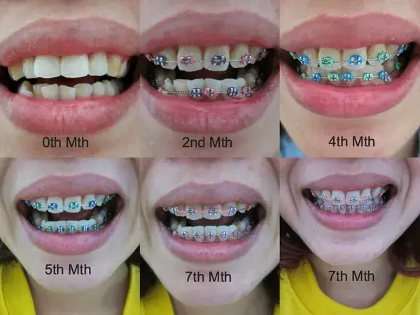 What Are the Best Braces Colors?