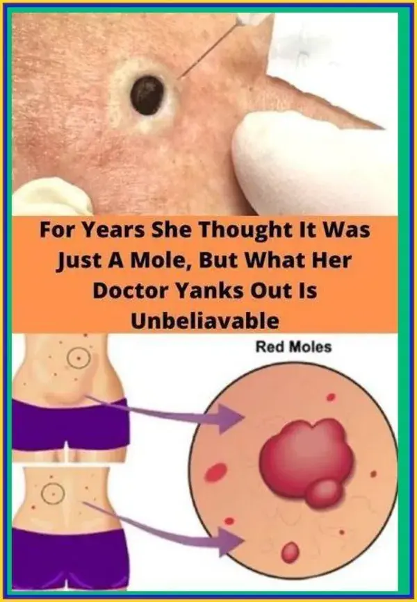 FOR YEARS SHE THOUGHT THAT IT WAS JUST A MOLE