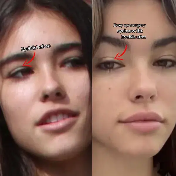 Madison Beer eyelid, foxy eye surgery and brow lift