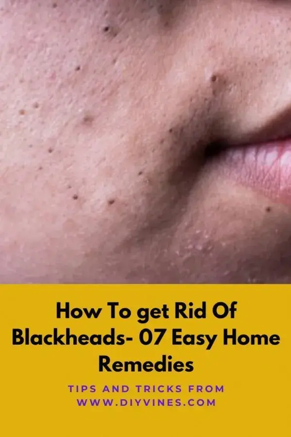 How To Remove Deep Blackheads Easy And Fast