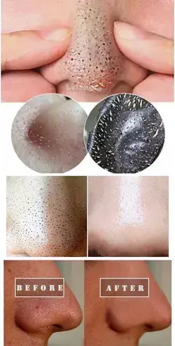 10 Best Blackheads Removal Skincare Tips