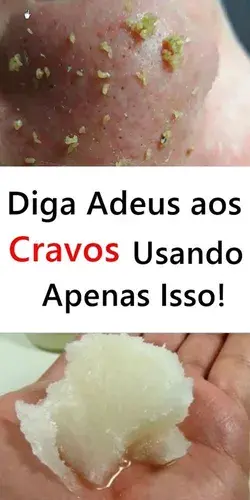 Diga Adeus aos Cravos Usando Apenas Isso