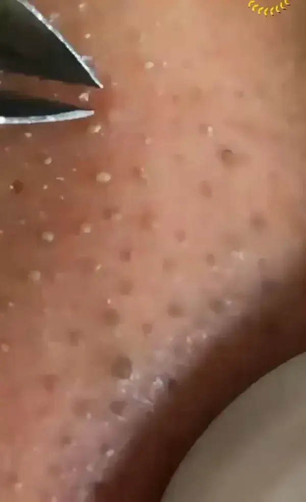 #acne #blackhead #pimplepop #pimple #blackheadremoval #satisfying