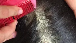 Flaky Scalp Fixes | Battle of the flakes | Huge dandruff flakes | Embedded Flakes