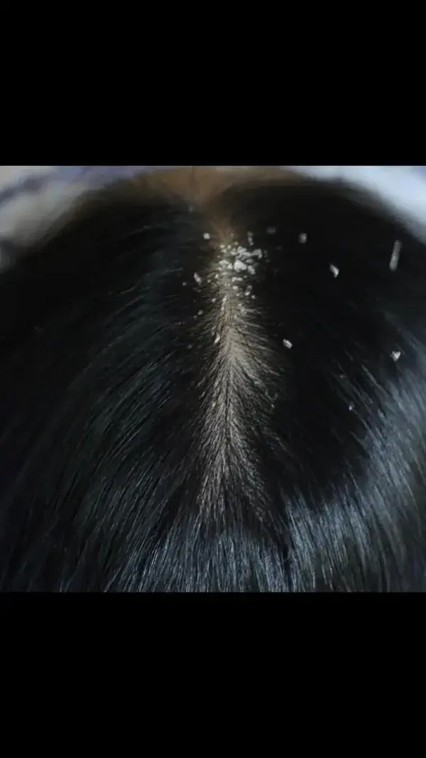 Relaxing Scalp Check