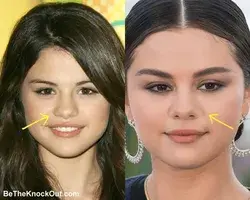 Selena Gomez Plastic Surgery Comparison Photos