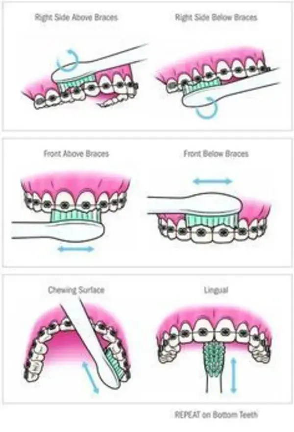 Braces care