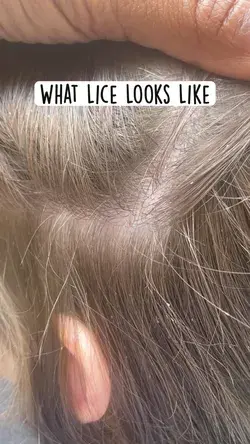 What Lice Looks Like