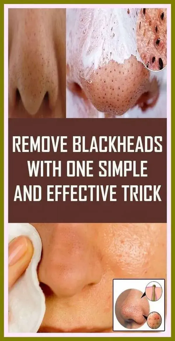 Remove Blackheads With One Simple And Effective Trick