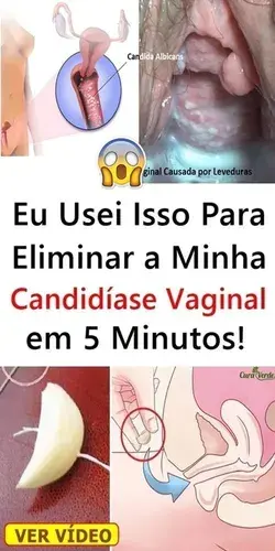 Eu Usei Isso Para Eliminar a Minha Candidíase Vaginal em 5 Minutos!