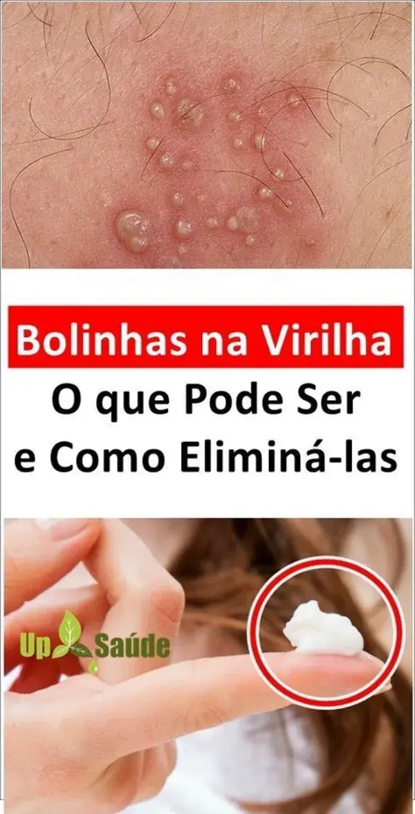 Bolha na Virilha - Saiba o que Pode Ser e Como Fazer Para Eliminá-las!