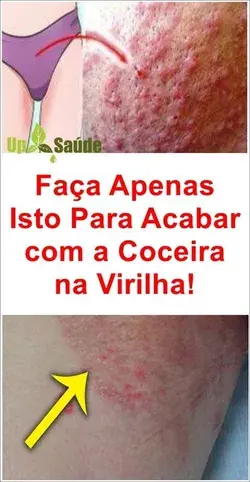 Remédio Caseiro Para Acabar com a Coceira Vaginal!