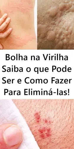 Bolha na Virilha Saiba o que Pode Ser e Como Fazer Para Eliminá-las!