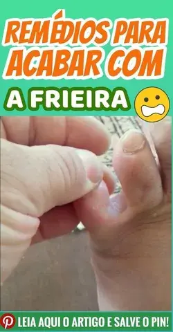 Elimine as Frieiras com Esse Remédio Caseiro Fácil de Preparar!