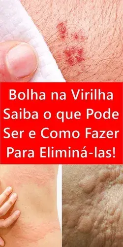 Bolha na Virilha Saiba o que Pode Ser e Como Fazer Para Eliminá-las!