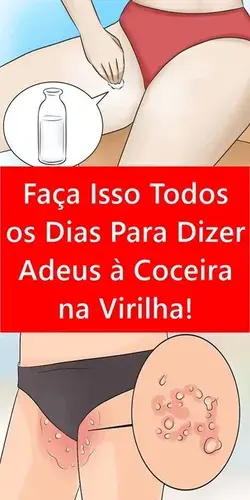 Faça Isso Todos os Dias Para Dizer Adeus à Coceira na Virilha!