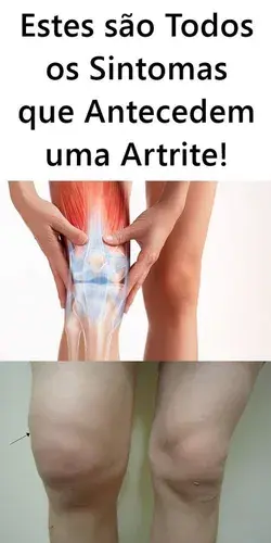 Estes são Todos os Sintomas que Antecedem uma Artrite!